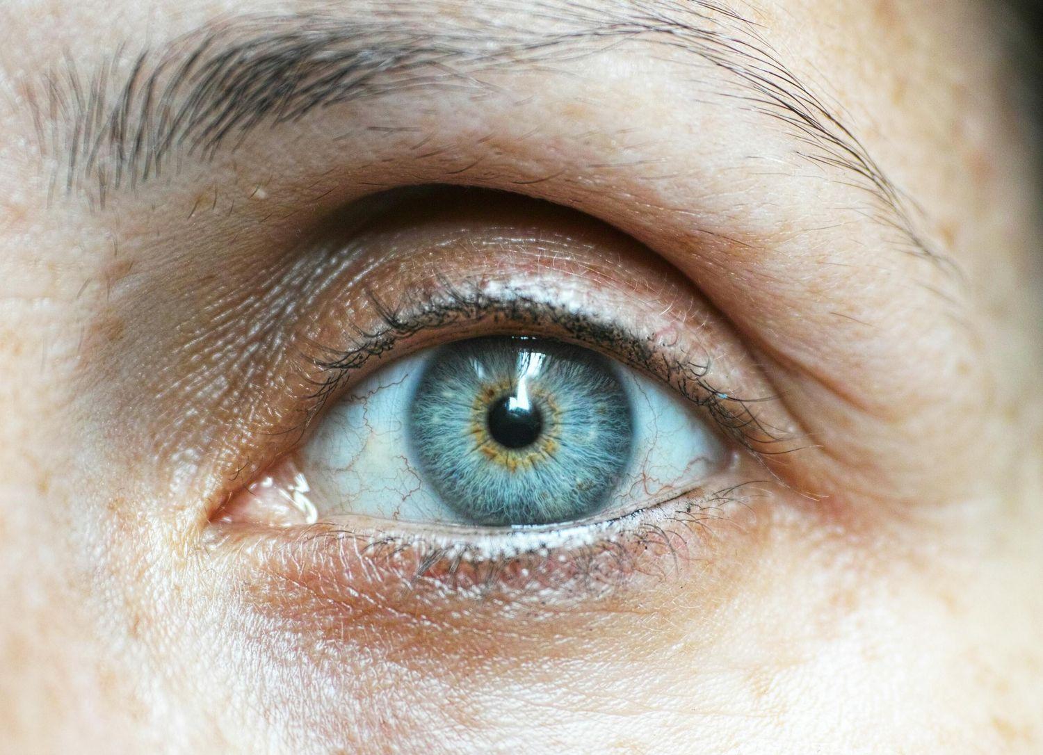 Nahaufnahme von einem Auge mit implantierter Linse