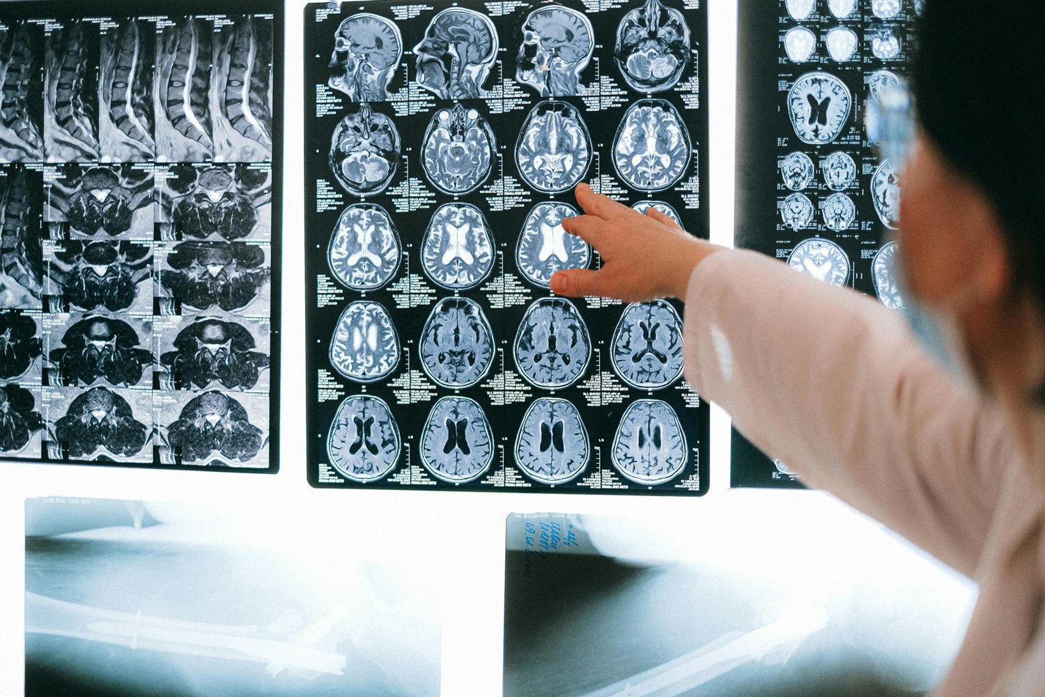 MRT-Aufnahmen, die im Rahmen der Morbus-Menière-Diagnostik gemacht wurden